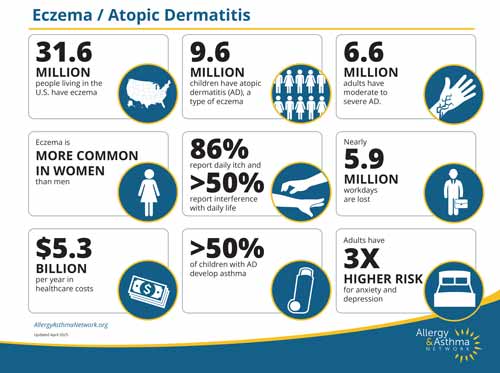 Infographic with eczema/atopic dermatitis statistics: 31.6M in the US affected, 9.6M children, 6.6M adults, more common in women, 86% report daily impact, $5.3B cost, over 50% of children develop asthma, 3X higher adult anxiety risk.